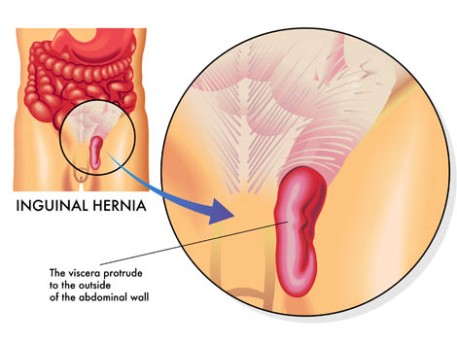 Open Inguinal-Femoral Hernia Repair by OrangeCountySurgeons.org  (2)